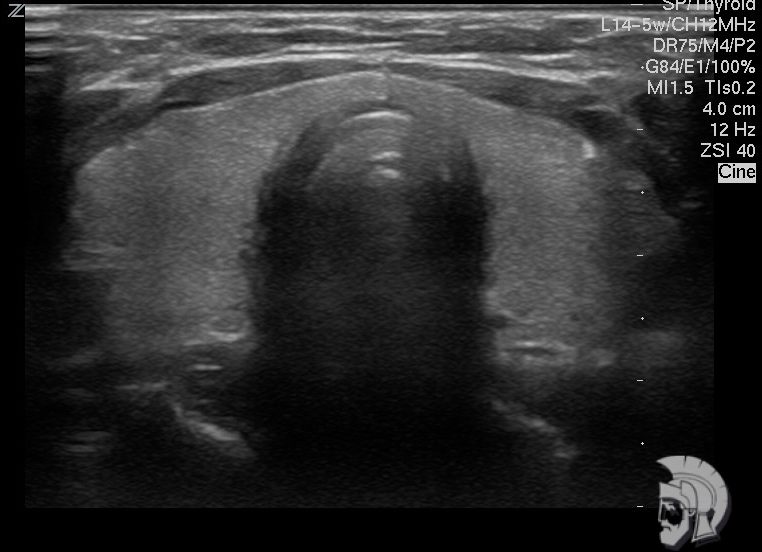 Нормальная структура щитовидной железы подростка 15 лет Нормальная структура щитовидной железы подростка 15 лет